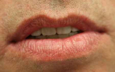 Lippenprofil der Implantatarbeit