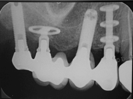 Röntgenbild der Zahnimplantate