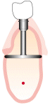 Dartstellung eines BASAL-Implantats