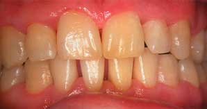 Zahnstein und Beläge entfernt