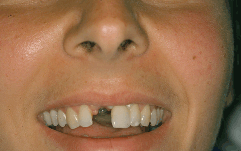 Zahnlücke mit Zahnimplantat versorgt